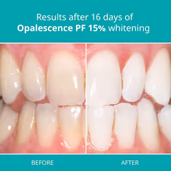 Teeth Whitening Gel Syringes 15% Mint - Teeth Whitening, Oral Health
