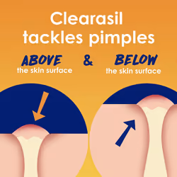 Clearasil Stubborn Acne Control 5in1 Spot Treatment Cream, Maximum Str