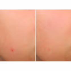 Bye Bye Brekout serum 30 ml