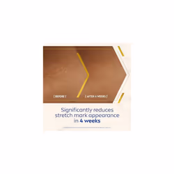 NIVEA Luminous 630 Anti Stretch Marks & Dark Spots Body Cream (200ml) 48-Hour Moisturising Cream Reduces Stretch Marks Sun Blemishes and Pigment S