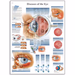 3B Scientific Human Anatomy - Diseases of the Eye Chart, Paper Version