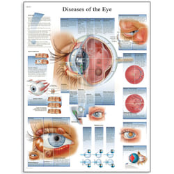 3B Scientific Human Anatomy - Diseases of the Eye Chart, Paper Version