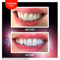 Colgate Max White Ultra Active Foam Teeth Whitening Toothpaste 75ml 2 Pack | whiter teeth in 3 days | enamel safe teeth whitening | teeth stain