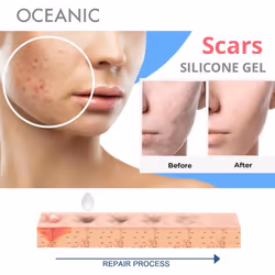 NoScar SILICONE GEL ALL KINDS OF SCARS STRETCH MARKS SKIN REGENERATION