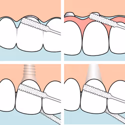 TePe Bridge and Implant Floss for Dental Implants  Bridges  and Braces  Dental Flossers  30 Pieces