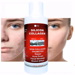 Skin Scars Silicon and Collagen Hydrolyzed Gel Resurfacing Skin Collagen Promoter For Indented Atrophic Rolling Face Scars By ...