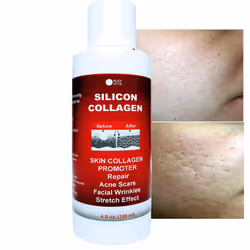 Skin Scars Silicon and Collagen Hydrolyzed Gel Resurfacing Skin Collagen Promoter For Indented Atrophic Rolling Face Scars By ALKA VITA