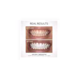 Colgate Max White Ultimate At Home LED Teeth Whitening Kit Enamel Safe Reverses Up To 20 Years Of Stains Whitening Pen & Smartphone Powered - Additional view 5