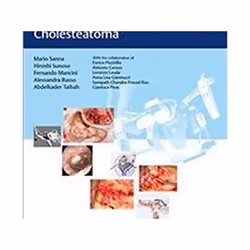ISBN Microsurgical Management of Middle Ear and Petrous Bone Cholesteatoma, Medicine, English, Hardcover, 710 pages